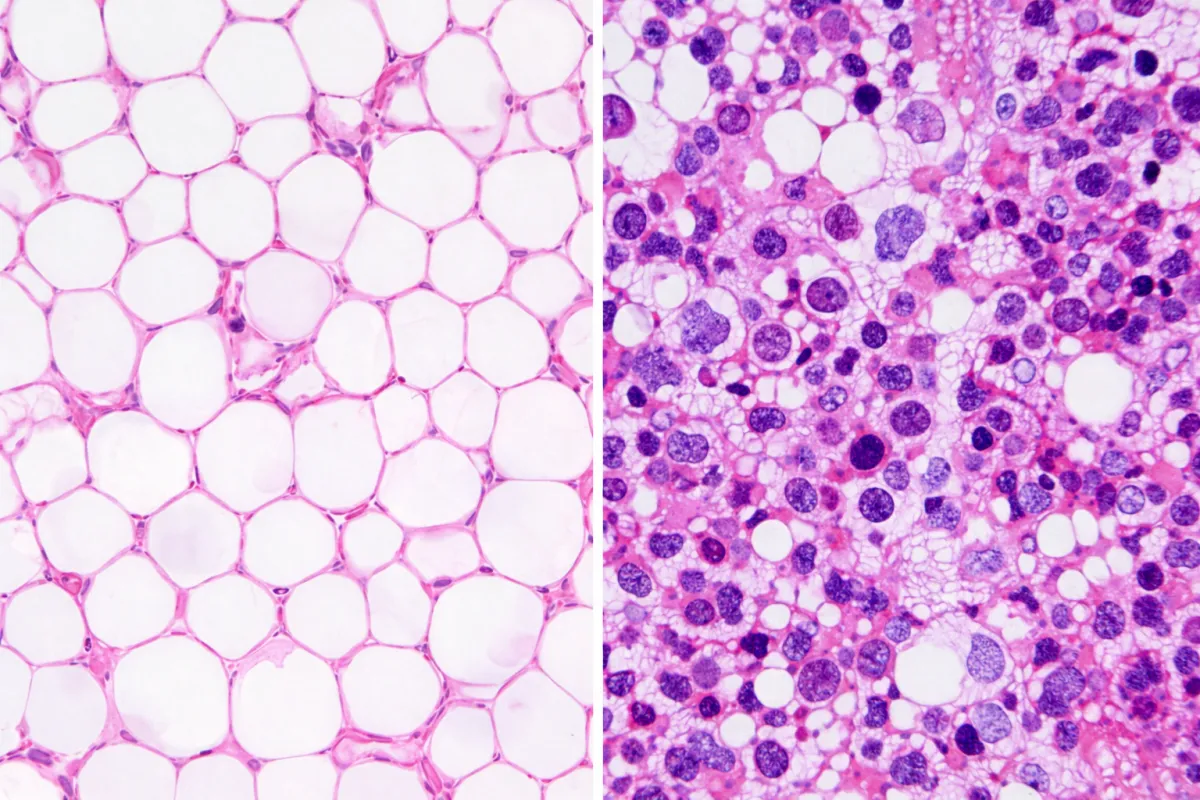 Immagine istologica comparativa che mostra a sinistra il tessuto adiposo con adipociti grandi e chiari, e a destra il midollo osseo ricco di cellule ematopoietiche dense, evidenziando le differenze biologiche tra le due fonti di cellule staminali.