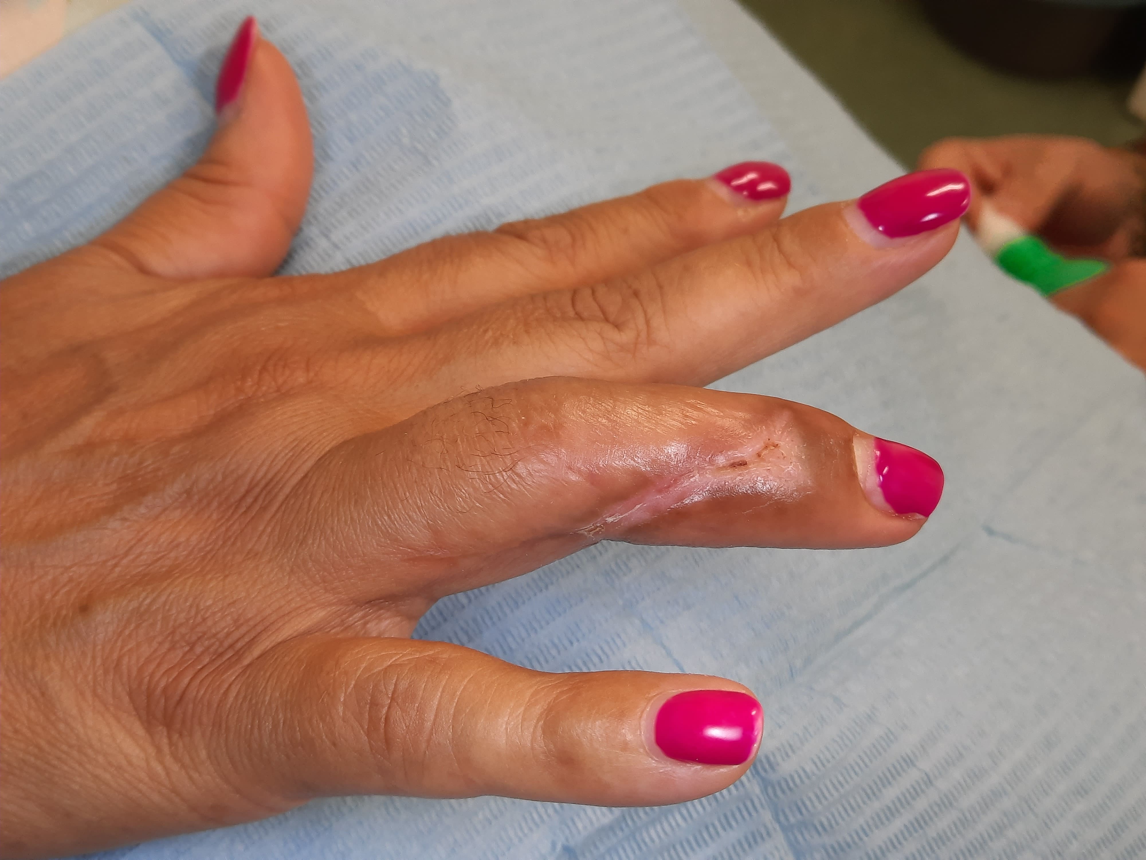 Mano femminile con dito lesionato in fase di guarigione: cicatrice lineare, cute lucida e vascolarizzazione recuperata dopo trattamento rigenerativo con PRF.