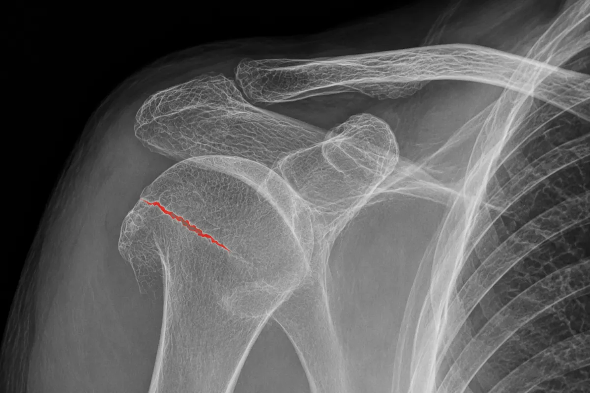 Radiografia della spalla destra con frattura ingranata della testa dell'omero evidenziata da una linea rossa. Immagine diagnostica che mostra una frattura prossimale dell'omero in paziente anziana con osteoporosi, trattabile nella maggior parte dei casi con terapia conservativa e riabilitazione mirata.