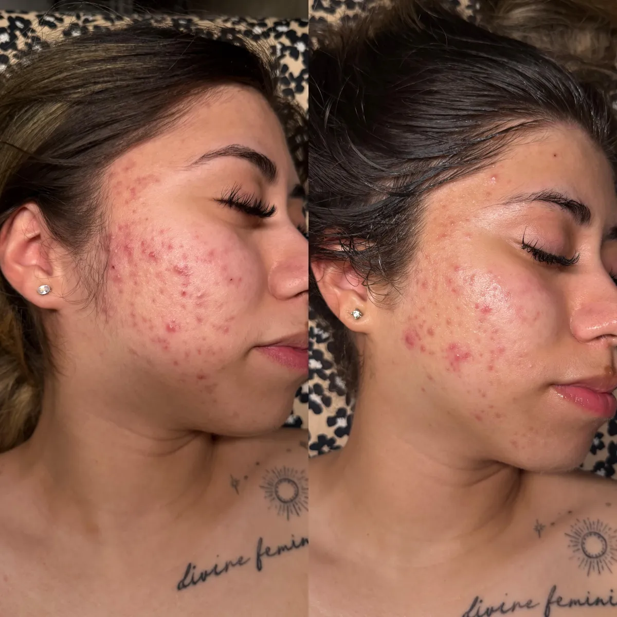 corrective skincarein acksonvilke forida and vrtual skincare aesthetician