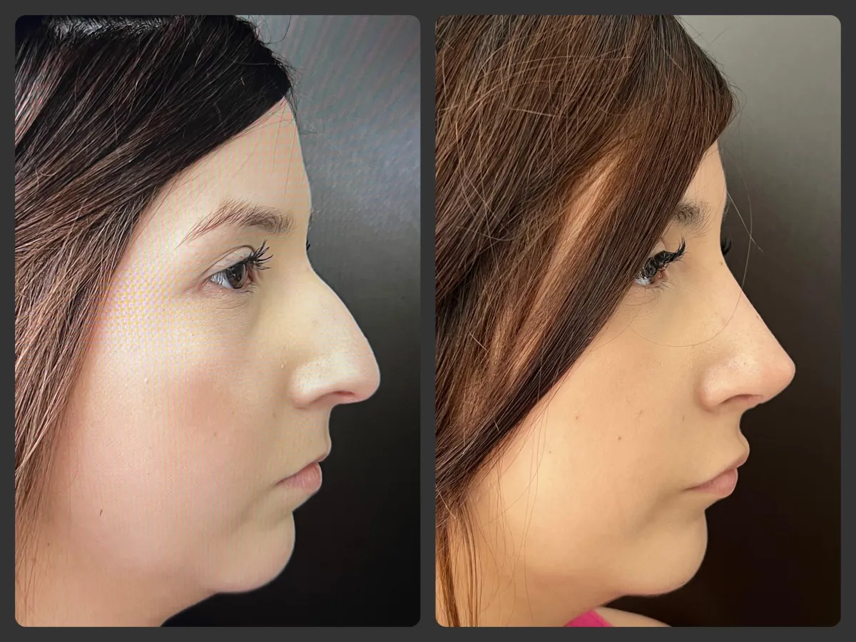 rinoplastia antes y después 