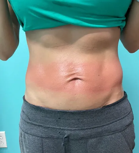 Client transformation after several sessions.