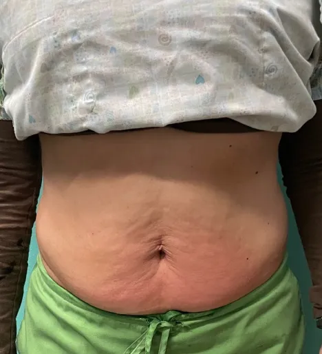 Client transformation after several sessions.
