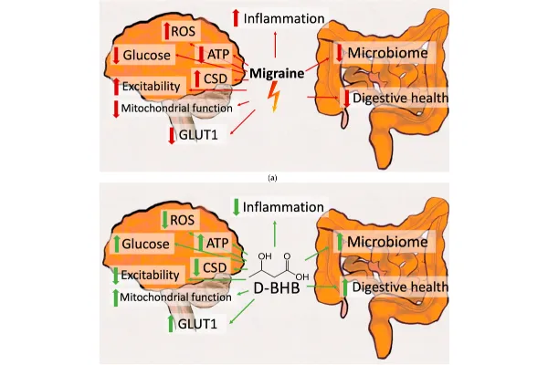 Potential Protective Mechanisms of Ketone Bodies in Migraine Prevention
