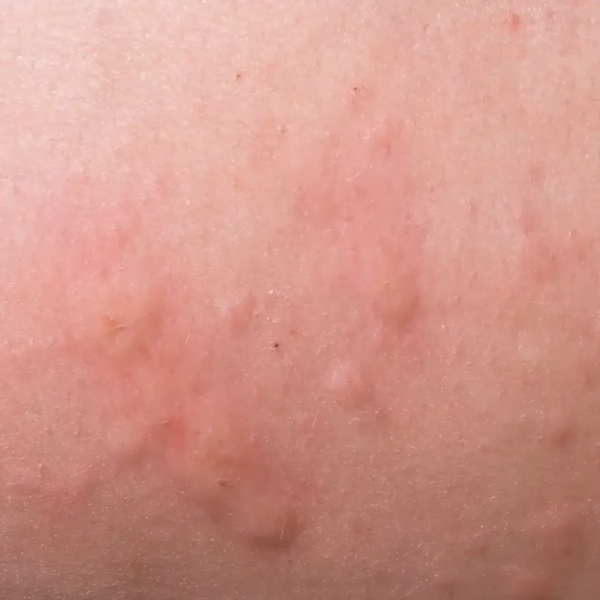 Skin irritation and redness on neck caused by mould-related sensitivity
