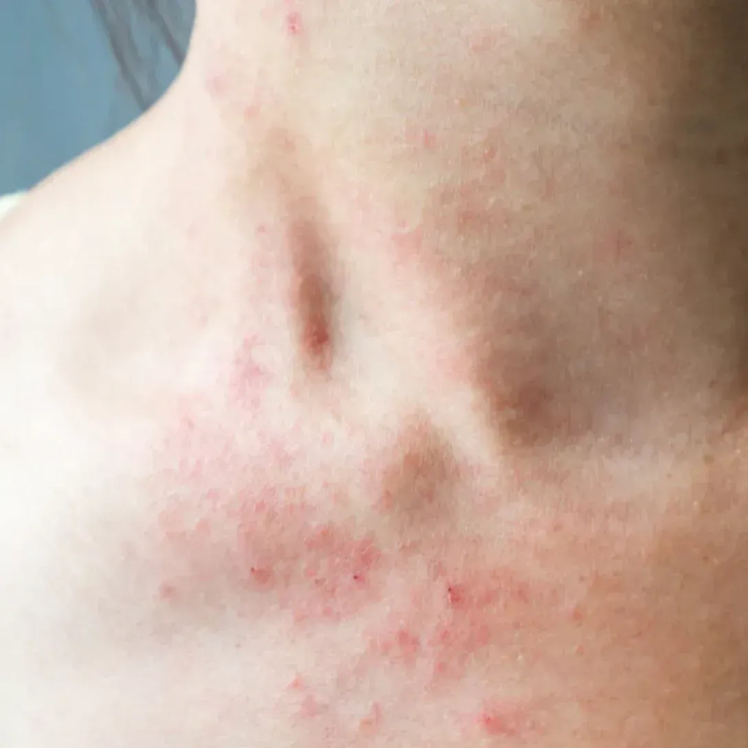Skin irritation and redness on neck caused by mould-related sensitivity