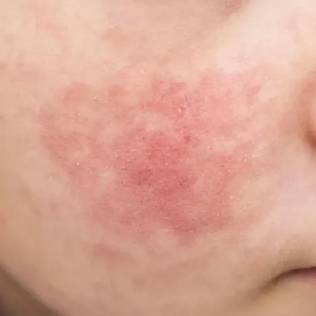 Skin irritation and redness on neck caused by mould-related sensitivity