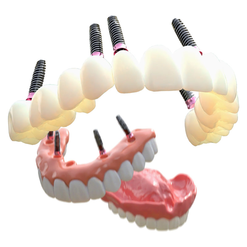 Denture, All on 4, 3 on 6. Evolution of dental restoration.