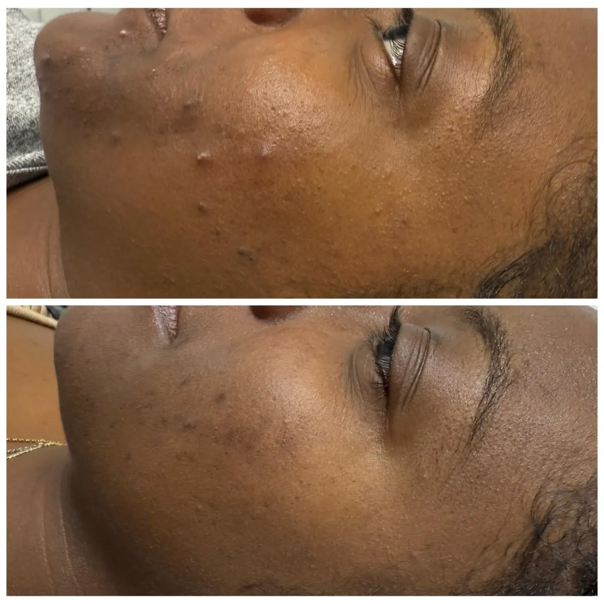 Before and after of acne correction