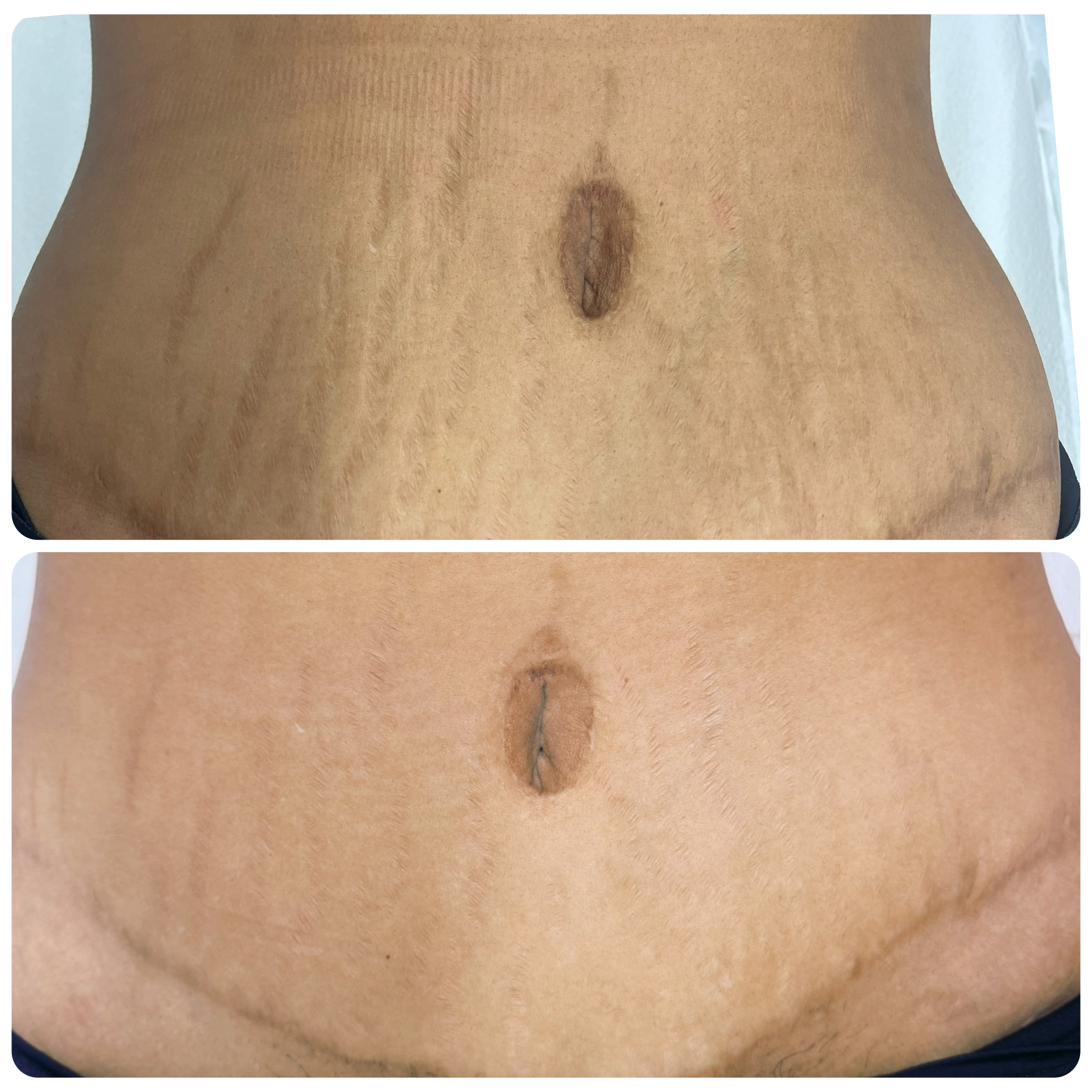 Close-up clinical photograph of a raised, darker-pigmented scar on skin, illustrating the type of scarring treated by the Glow Away Protocol