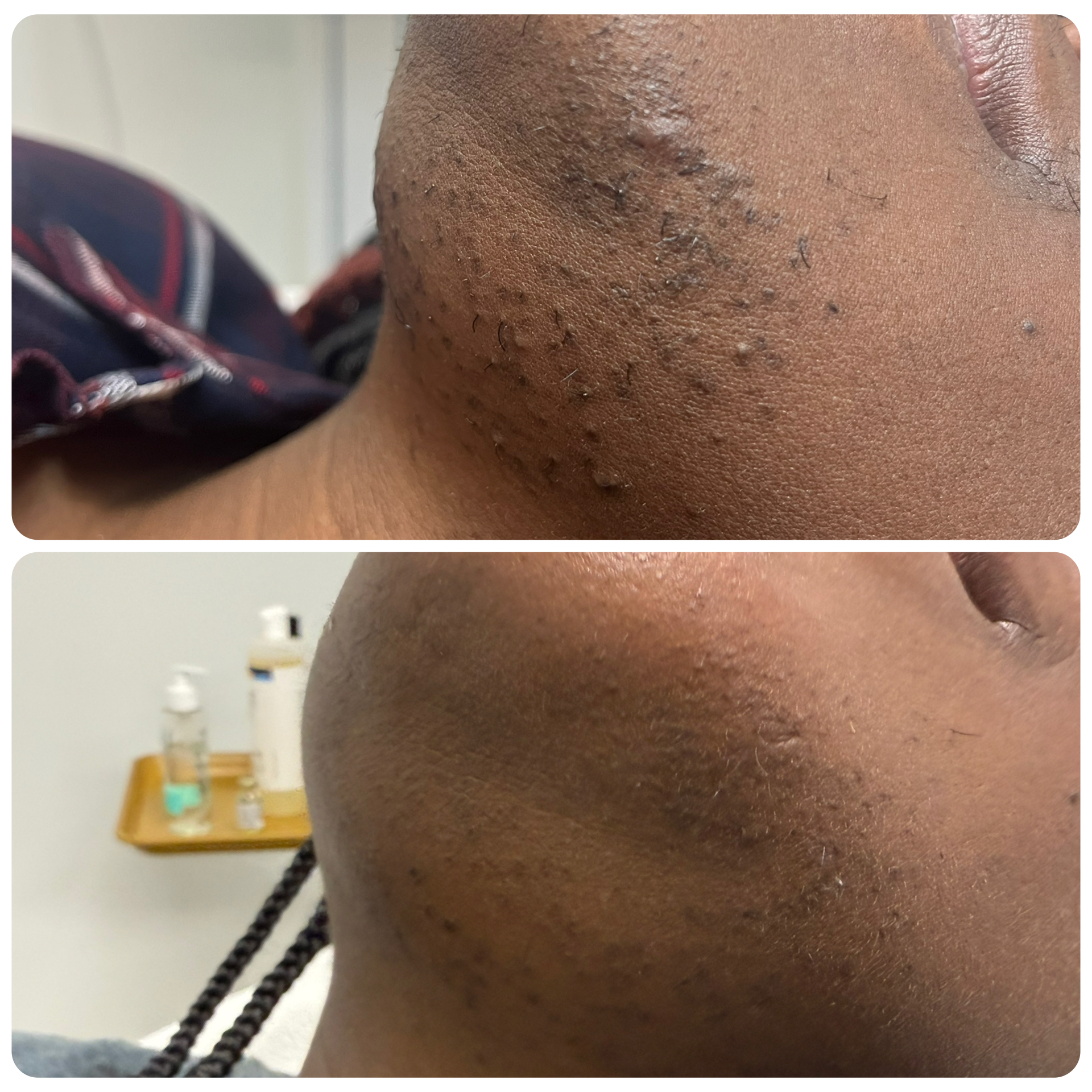 Before and after of hyperpigmentation corrections
