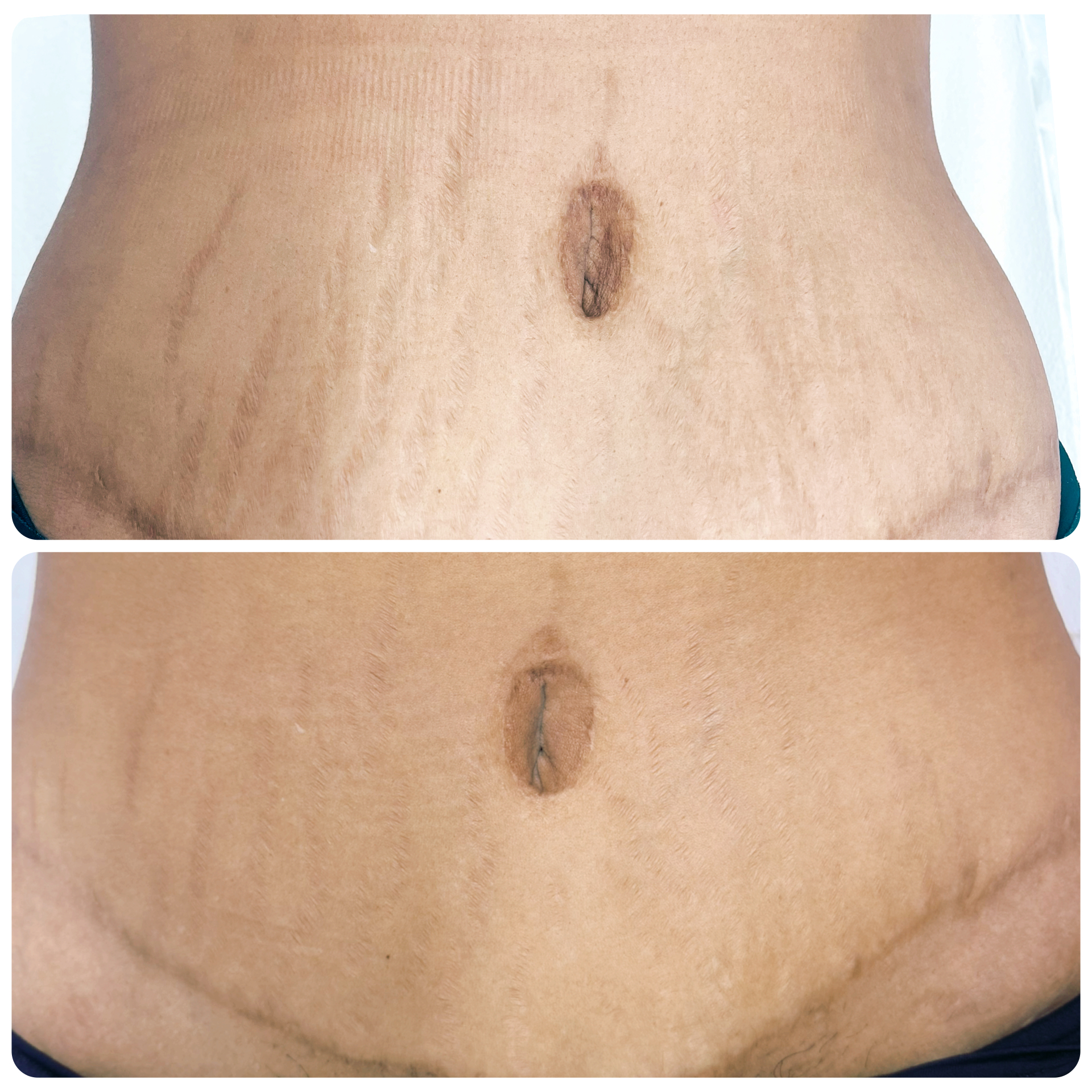 Before and after of scar lightening