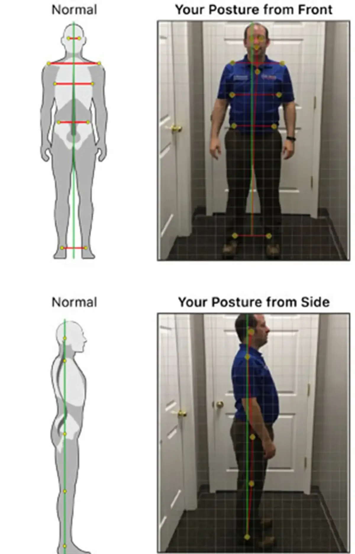 Software de análisis de postura digital para diagnóstico quiropráctico