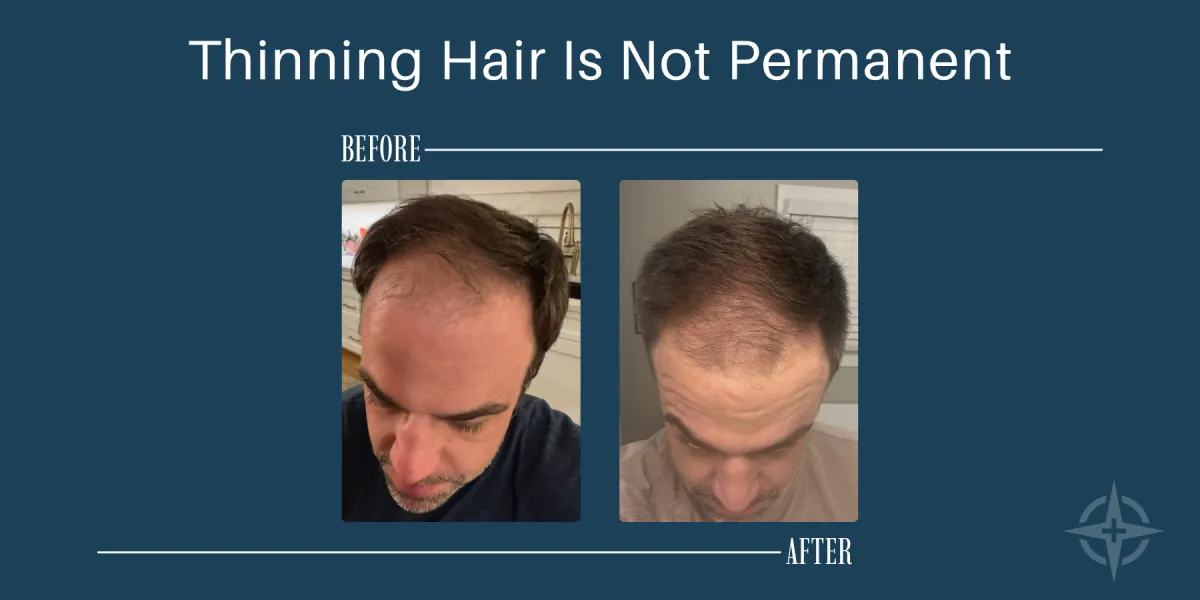 Side by side before and after of Logan Taylor showing thicker hair after regenerative hair restoration.