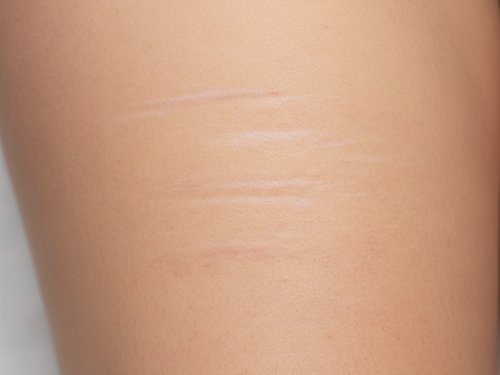 Jacksonville, FL Stretch Marks