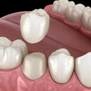 Same-day veneers and crowns/cosmetic dentistry Grand Junction