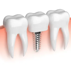 Dental Implants in Grand Junction, CO