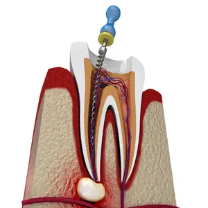 root canals in Grand Junction, CO