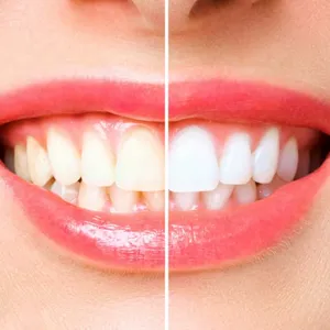teeth whitening solutions in Grand Junction, CO