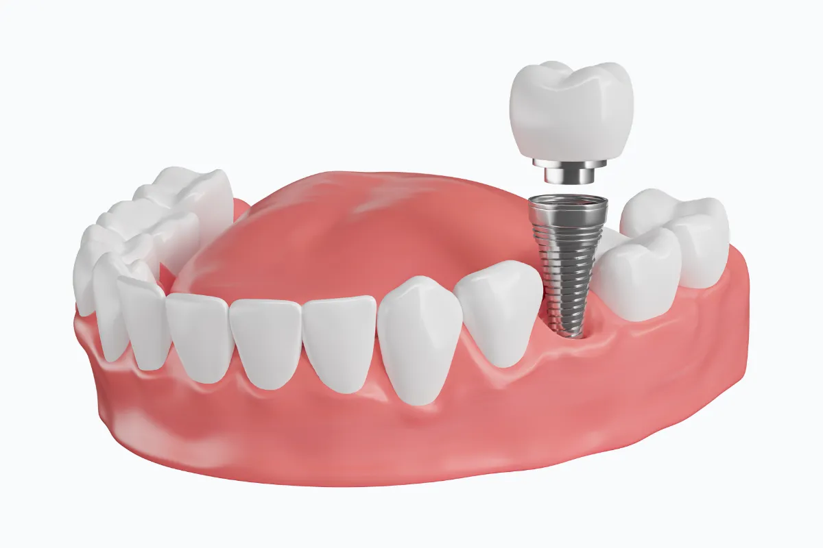 dental implants in Grand Junction, CO