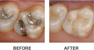 CEREC same day crowns and veneers
