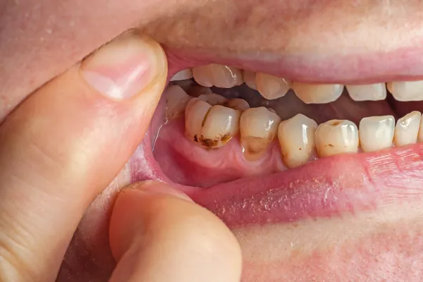 Understanding Gum Exams and Scaling and Root Planing