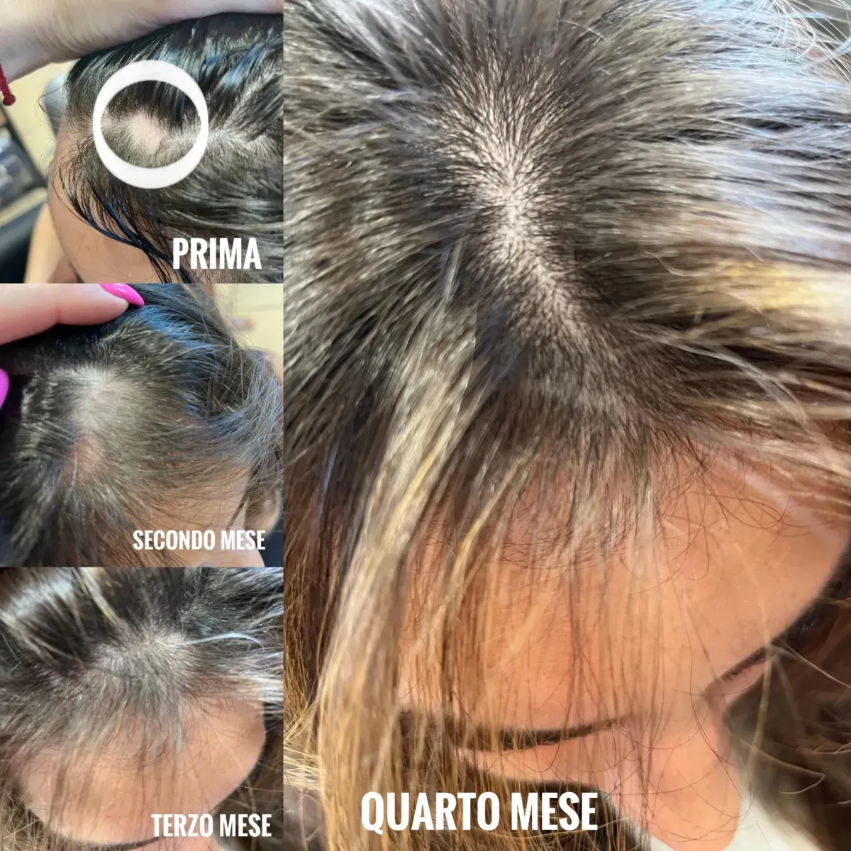 Alopecia Areata: Cos’è e come intervenire a Verona e San Marino