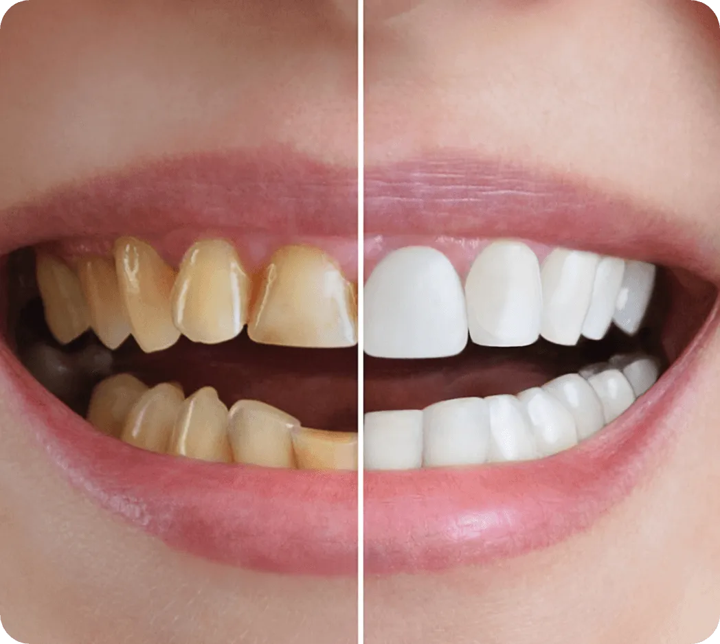 teeth whitening before and after