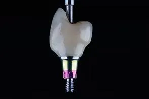 Dental Implants, Great Impressions Dental Lab, Richmond VA