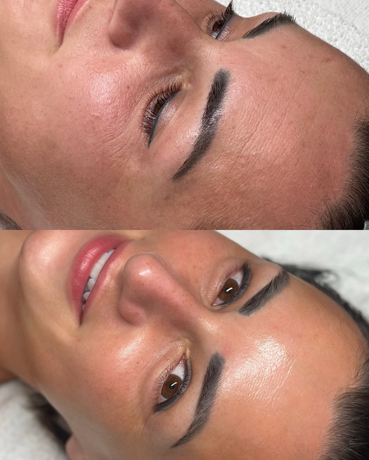 peel treatment boca raton