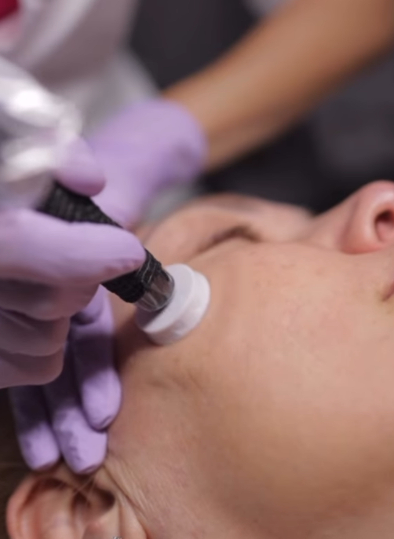 Chemical peel Boca Raton