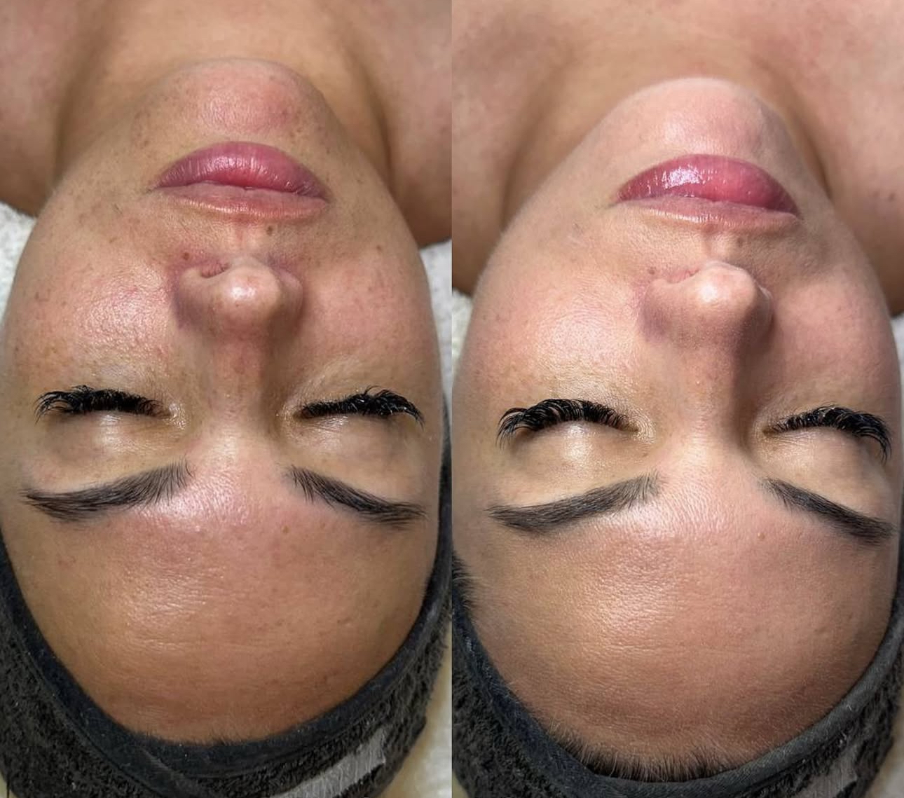 Chemical peel south florida