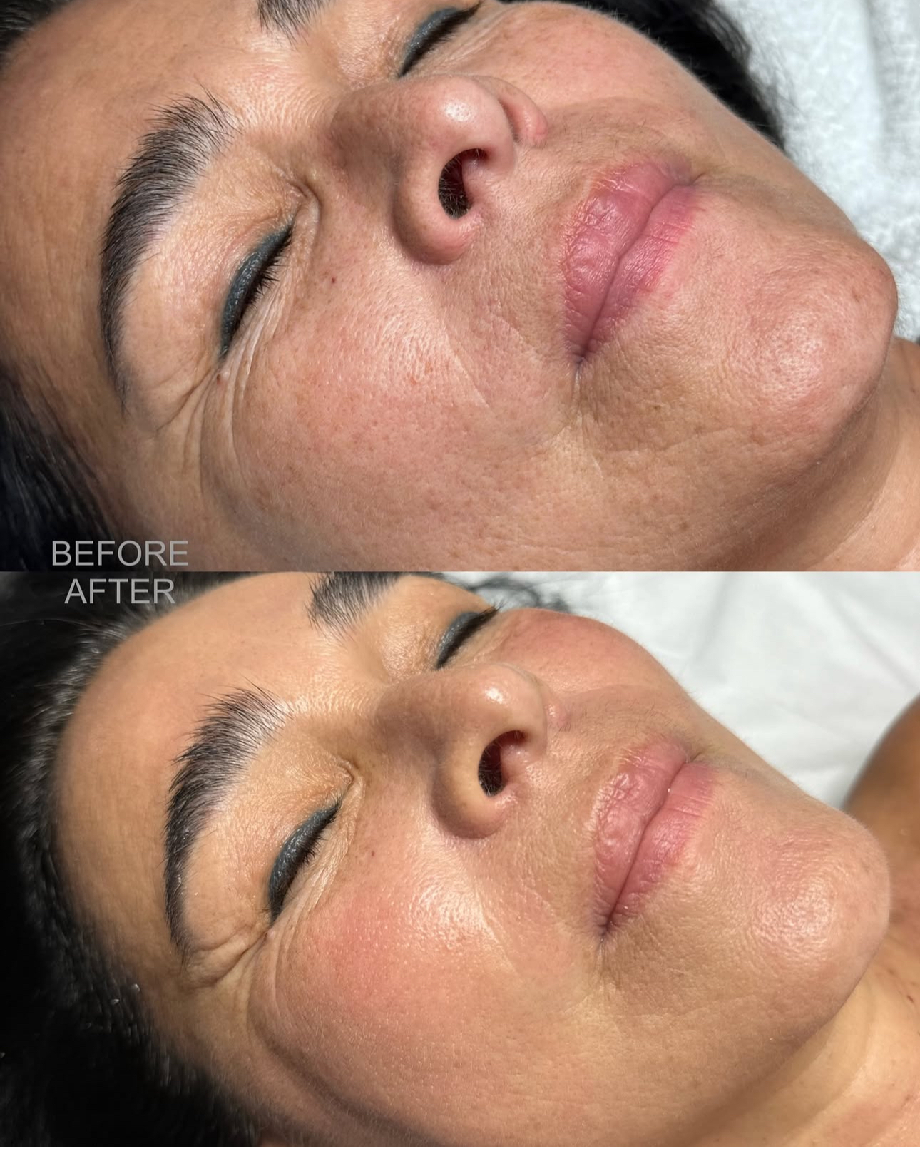 anti aging peel near me