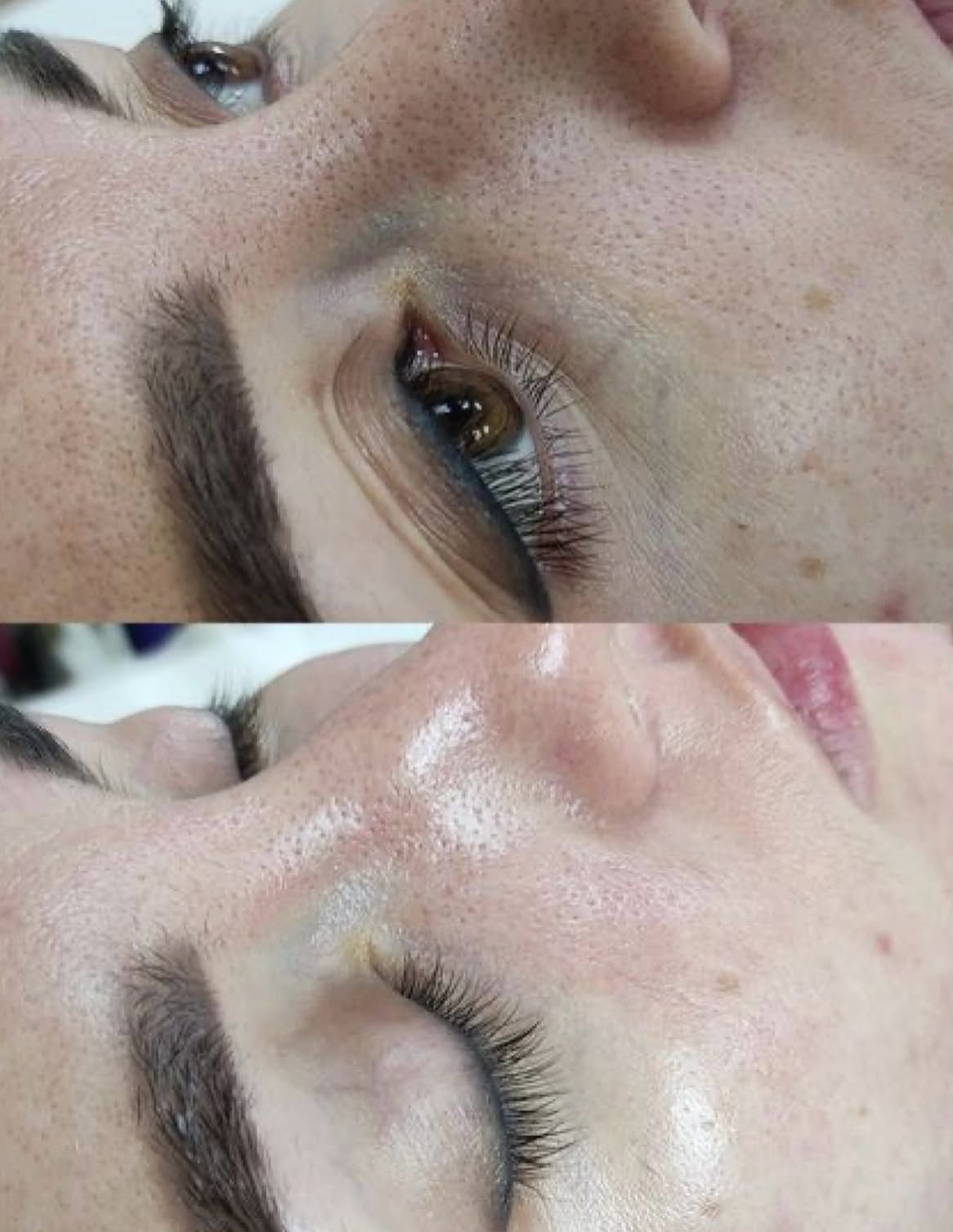 treatment to reduce face pigmentation