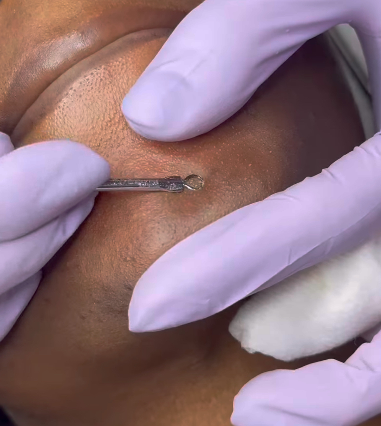 face cleansing facial extraction