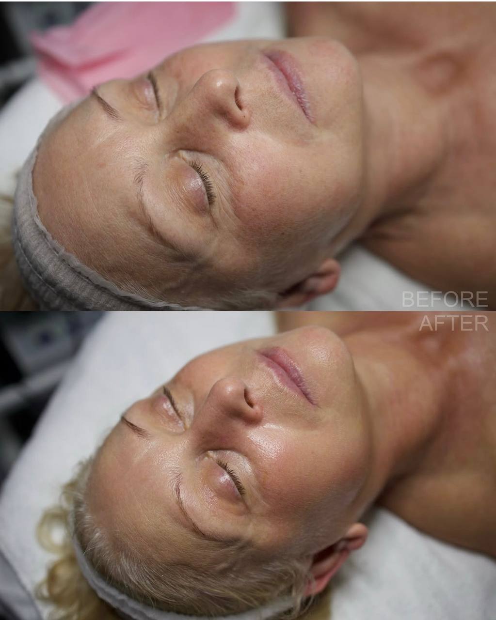 anti-aging facial Boca Raton