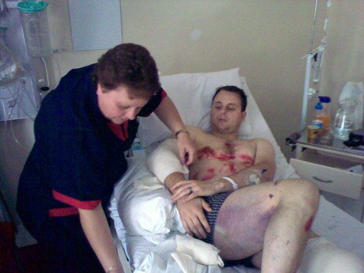 Pieter laying in a hospital bed. His injuries sustained can be seen in this image.