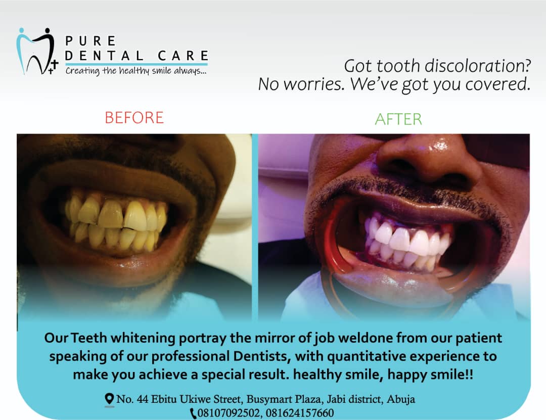 before and after tooth discoloration treatment at Pure Dental Care - Trusted Eye Clinic in Utako, Abuja 