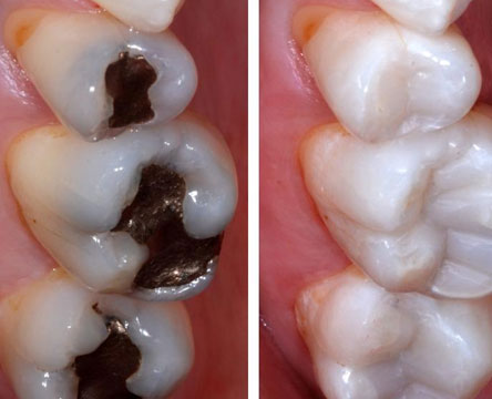 Fillings at MOLARDENT Dental Prostheses and Restorative Centre - Trusted Dental Clinic in Alagbaka, Akure , Ondo state