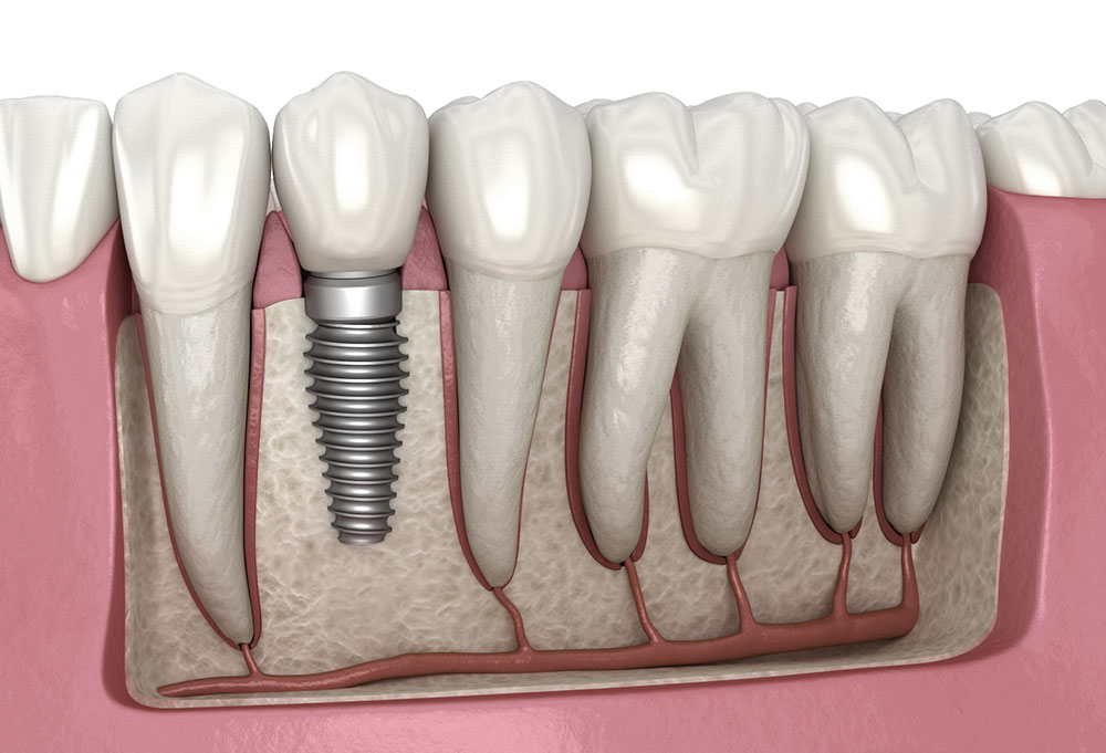 Dental Implants at MOLARDENT Dental Prostheses and Restorative Centre - Trusted Dental Clinic in Alagbaka, Akure , Ondo state