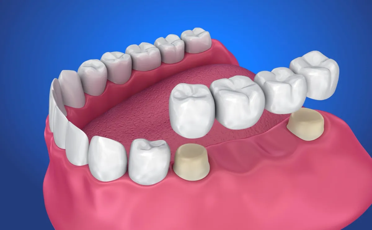 Bridges at MOLARDENT Dental Prostheses and Restorative Centre - Trusted Dental Clinic in Alagbaka, Akure , Ondo state