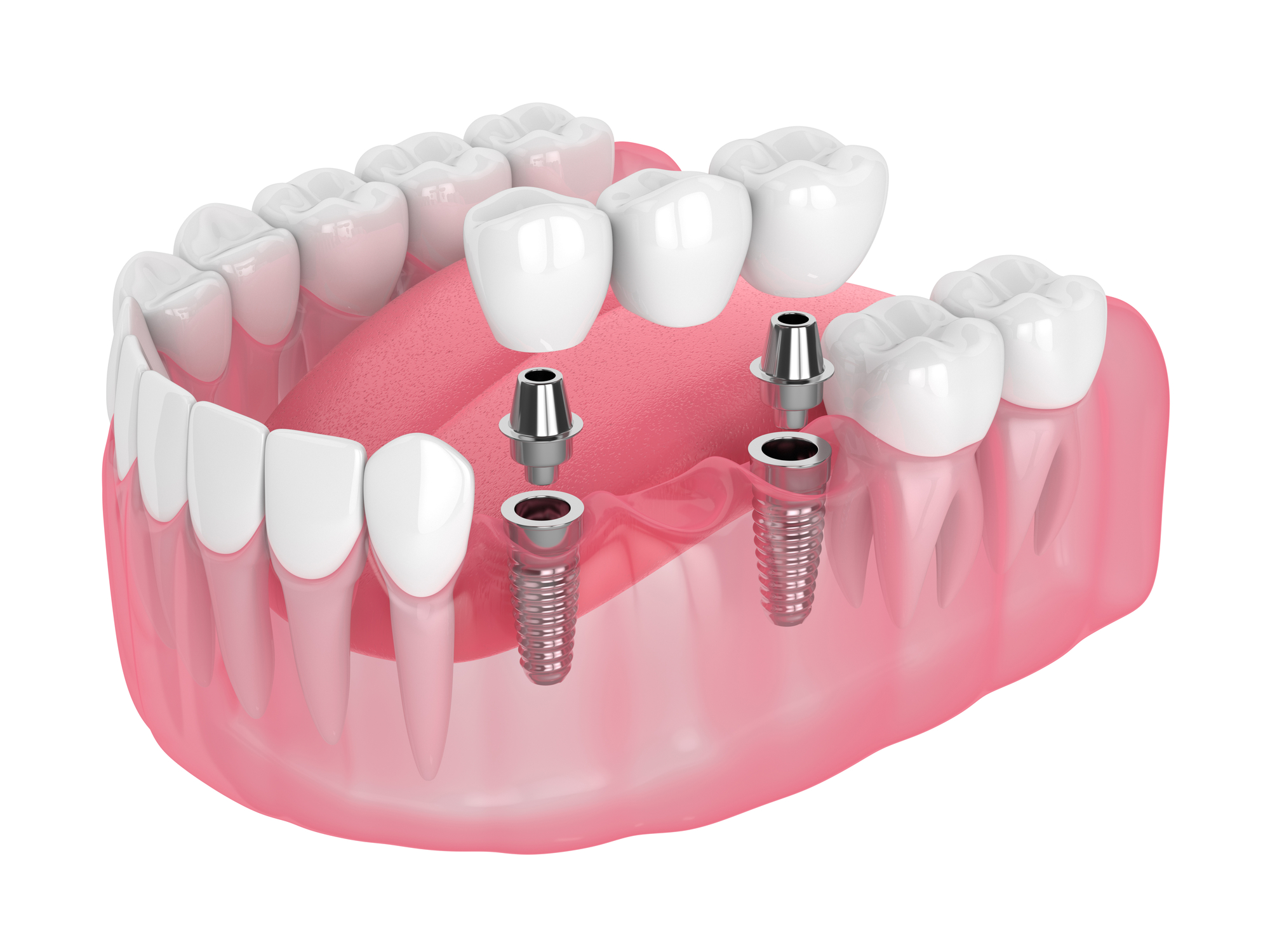 Crowns at MOLARDENT Dental Prostheses and Restorative Centre - Trusted Dental Clinic in Alagbaka, Akure , Ondo state