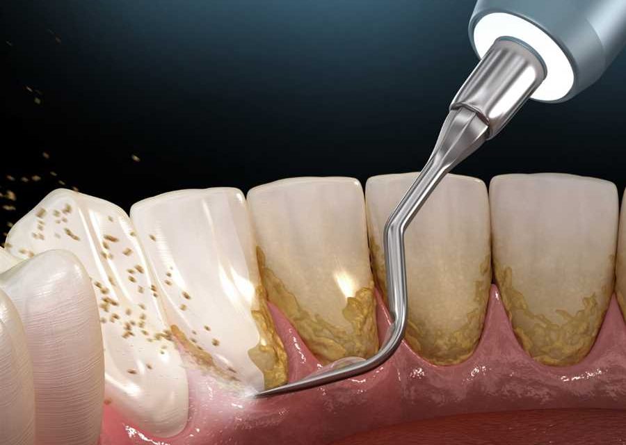 Scale and Polish at MOLARDENT Dental Prostheses and Restorative Centre - Trusted Dental Clinic in Alagbaka, Akure , Ondo state