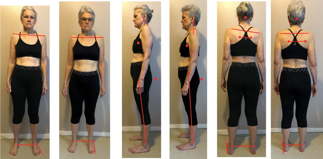 Robyn before-and-after photos showing changes in posture and body alignment for knee, shoulder, and hip pain