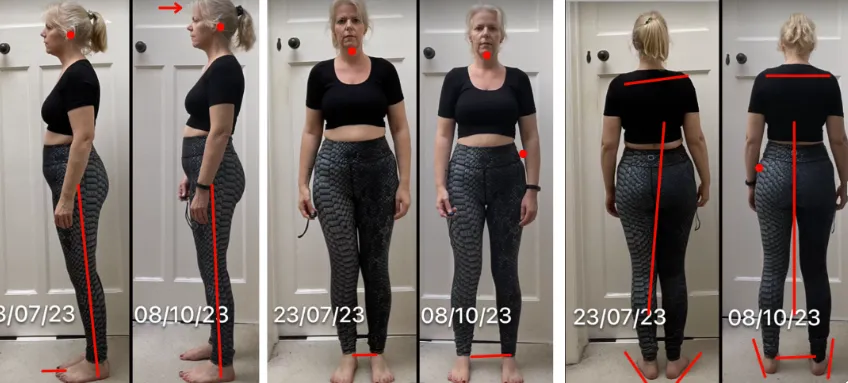 Jacki before-and-after photos showing changes in posture and body alignment for back and foot pain