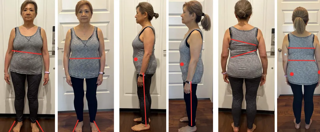 Before-and-after photos showing changes in posture and skeletal alignment for hip pain and scoliosis