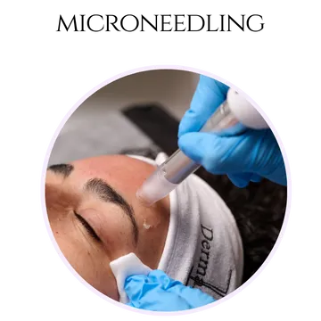 Microneedling in Surrey, BC