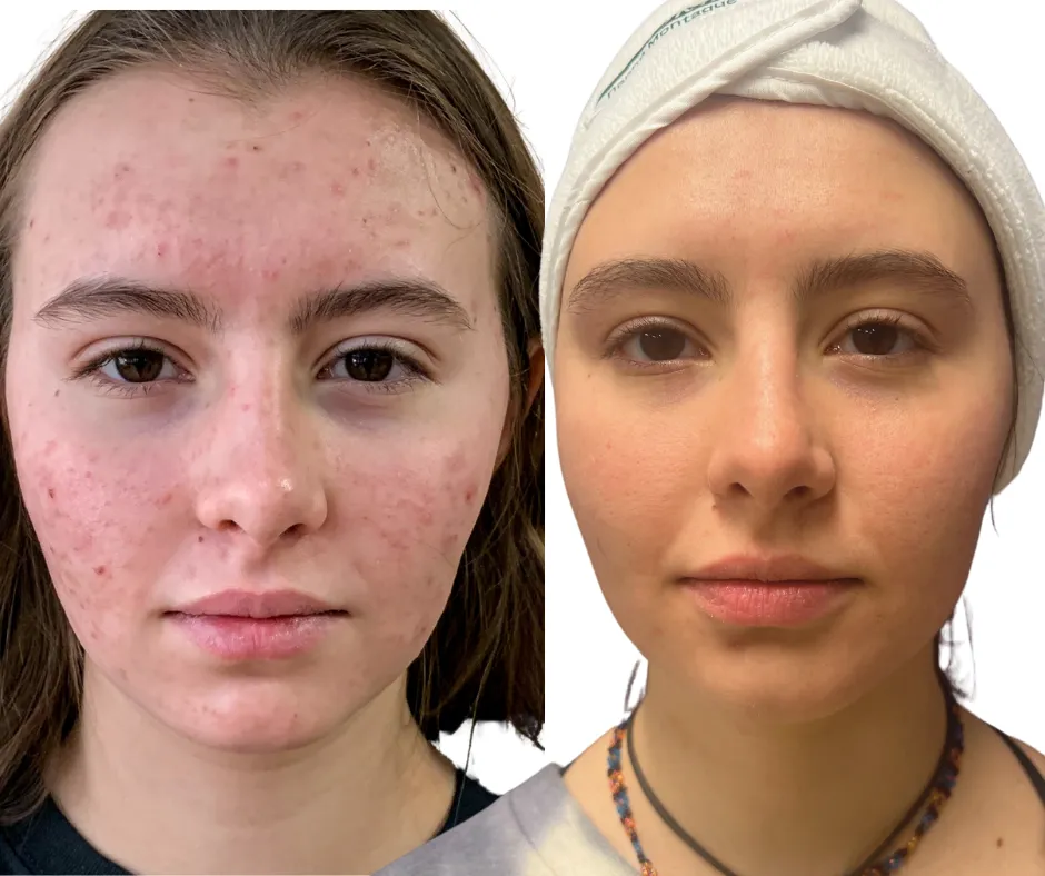 Teen acne solutions