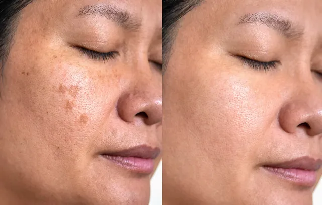 Clinical unedited before treatment photograph showing skin texture and baseline irregularities