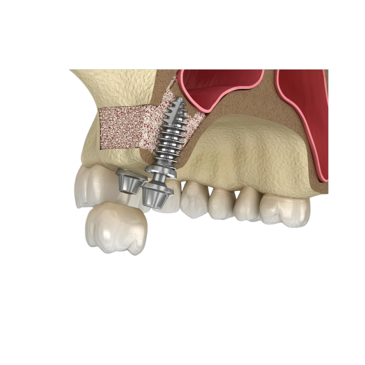 SINUS LIFT PROCEDURE IMAGE